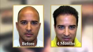 Hair Transplantation Surgery Video