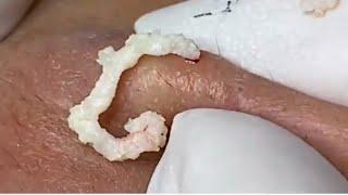 Big blackheads or cysts? Cistos ou cravos gigantes? Relax and enjoy! best videos of: acne, espinhas.