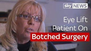 Eye Lift Patient On Botched Cosmetic Surgery