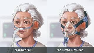 Nasal high‐flow therapy versus NIV in COPD patients with chronic respiratory failure