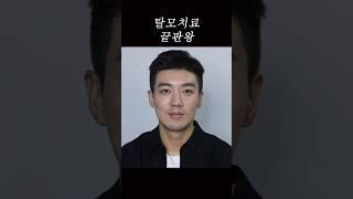 탈모치료 다 해봤는데 안된다면? #두피문신