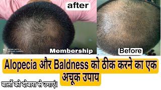 Alopecia treatment in just six months natural beauty and hair treatment खोए हुए बालों को वापस पाएं