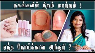 உங்கள் விரல்நகம் சொல்லும் நோய் அறிகுறிகள் ! | Nail Health Tips | Dr. B.Yoga Vidhya