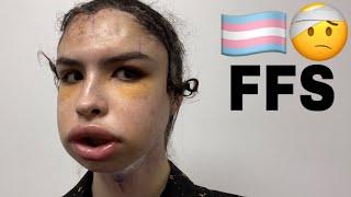 Facial Feminization Surgery || Tyler Brown