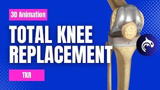 Total Knee Replacement (TKR): Condition, Treatment, and Surgery - 3D Animation