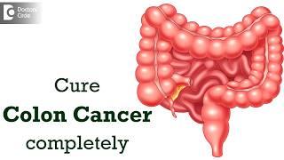 Is Colon Cancer curable? Is it easy to cure? - Dr. Parameshwara C M