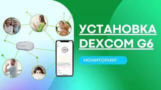 Установка мониторинга Dexcom G6