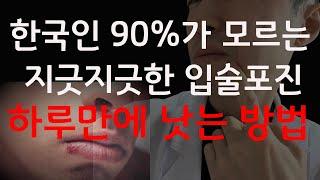헤르페스 입술포진 하루만에 낫는 방법. 더이상 고통받을 필요가 없습니다!. 헤르페스
