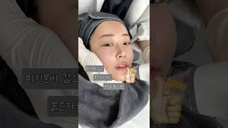 효과 좋은 모공레이저 후기 #모공레이저 #모공축소 #모공수축 #엑소좀 #포텐자레이저