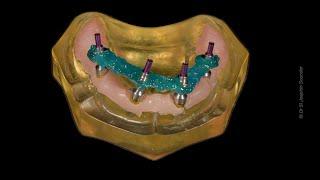 Step-by-Step All-on-4 Impression Techinique #allonX #allon4 #allon6 #fullmouth #zygomaticimplants