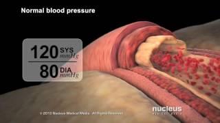 Asian Heart Hospital - what is high blood pressure?