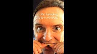 Tom, and his  'life changing' clip in veneers