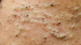 Get READY for RADIANT Skin with Korea's 7 Blackhead Removal Secrets!