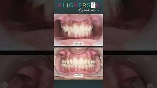 Smile Transformation Starts Here | Clear Aligners | Hyderabad | Invisible Braces | Aligners4u