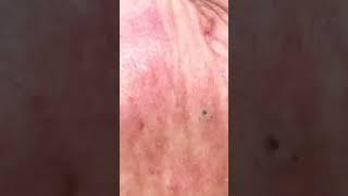 Some video-worthy blackheads on the face, wouldn't you say?