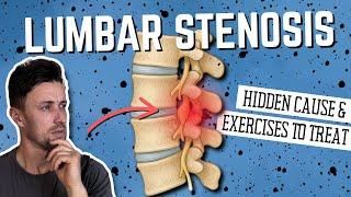 The HIDDEN Cause of Lumbar Stenosis (& Exercises to Treat)