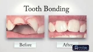 Cosmetic Bonding in Beirut Lebanon - Dentist Lebanon