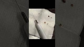 Skin Tag removal on armpit