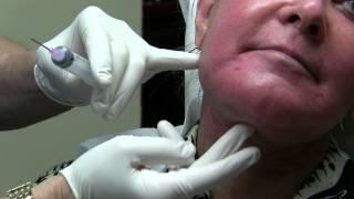 Facelift Seroma Aspiration by Dr. Joe Niamtu, III