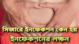 যে কারনে সিজারে ইনফেকশন হতে পারে||সিজারে ইনফেকশন কেন হয়||সিজারে ইনফেকশনের লক্ষন