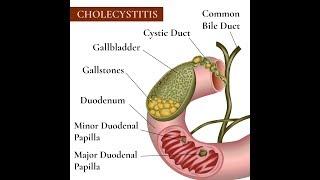 Understanding A Gallbladder Injury And Medical Malpractice Cholecystitis