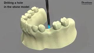 Dentium Guide System