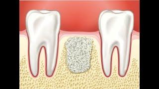 Имплантация зубов при недостаток костной ткани. Костная пластика в стоматологии Диалог