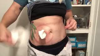 Coloplast 2 piece ostomy bag change #ostomybag