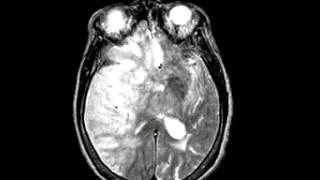 Cerebrovascular Disease Fatal stroke