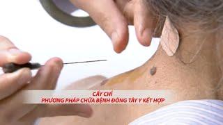 Cấy chỉ -  Phương pháp chữa bệnh Đông Tây y kết hợp| VTC14