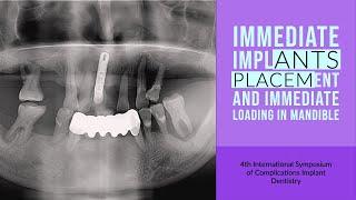 Immediate Implants Placement and Immediate Loading in Mandible