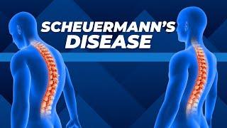 Top Three Exercises for Scheuermann's Disease