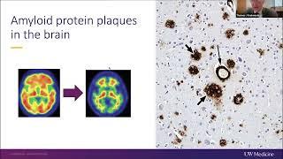 An Update on Lecanemab for Early Stage Alzheimer’s Disease