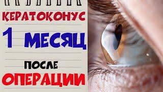  КЕРАТОКОНУС ‍️ Через 1 МЕСЯЦ после операции в клинике Арцыбашева  Контрольное обследование