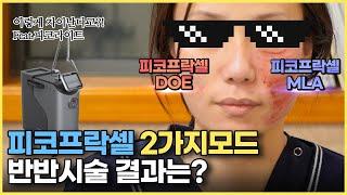 아셨나요? 피코프락셀 2가지모드(MLA & DOE) 이렇게 차이가 나네요_모공,흉터,색소 치료합시다.