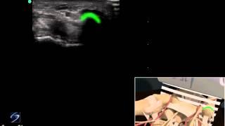 3D Cómo hacer: Examen ecográfico del canal de Guyon - Ecógrafo de SonoSite