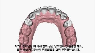 D1 Dental 디원치과 아미절라인 AMISalign 투명교정 박*수 님 케이스리포트