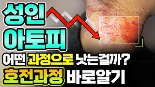 최초공개성인 아토피피부염의 호전과정을 알려드립니다.부위별 호전반응과 순서