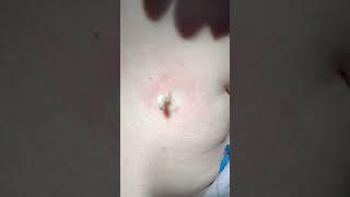 A Silkworm Popped Out From His Skin! | CONTOUR DERMATOLOGY