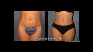 Silk Touch Medspa Liposuction Abdomen Area Part 2