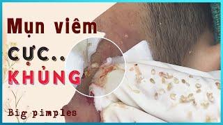 Big Cystic Acne Blackheads Extraction Blackheads & Milia, Whiteheads Removal Pimple Popping