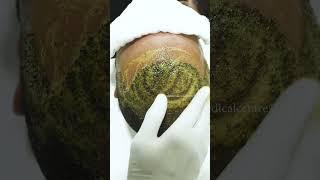 It's not just a regular head wash  | Hair Transplant Clinic  | Dadu Medical Centre