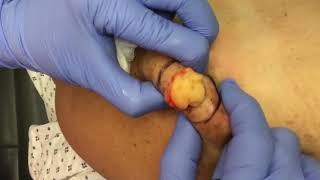 Lipoma Removal on Shoulder