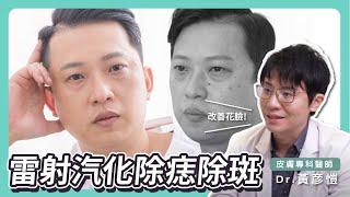 雷射汽化除痣除斑驚人實測，阿憲透過除痣除斑療程改善花臉 台北教主 皮膚專科黃彥愷醫師