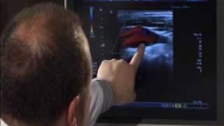 Carotid Artery Ultrasound