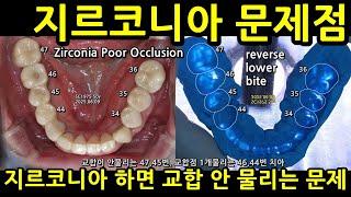 지르코니아 문제점. 교합 안 물리는 문제. 차라리 PFM, 금니를 하는게 치아에 좋다. 지르코니아 교합이 안 물리는건 교합조정시간 줄이는 꼼수. 지르코니아03강 2025_06_19
