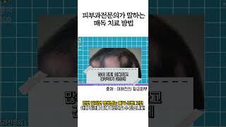 피부과전문의가 말하는 매독 치료 방법