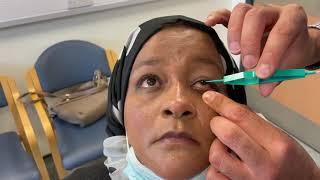 Punctal plug insertion for dry eye syndrome