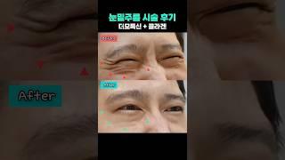 눈밑 주름 잡는 최고의 시술  더모톡신 + 콜라겐 주사 리얼후기