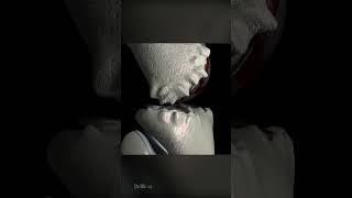 Knee Osteoarthritis With Osteophytes